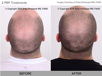 Platelet-rich plasma (PRP) hair restoration before and after